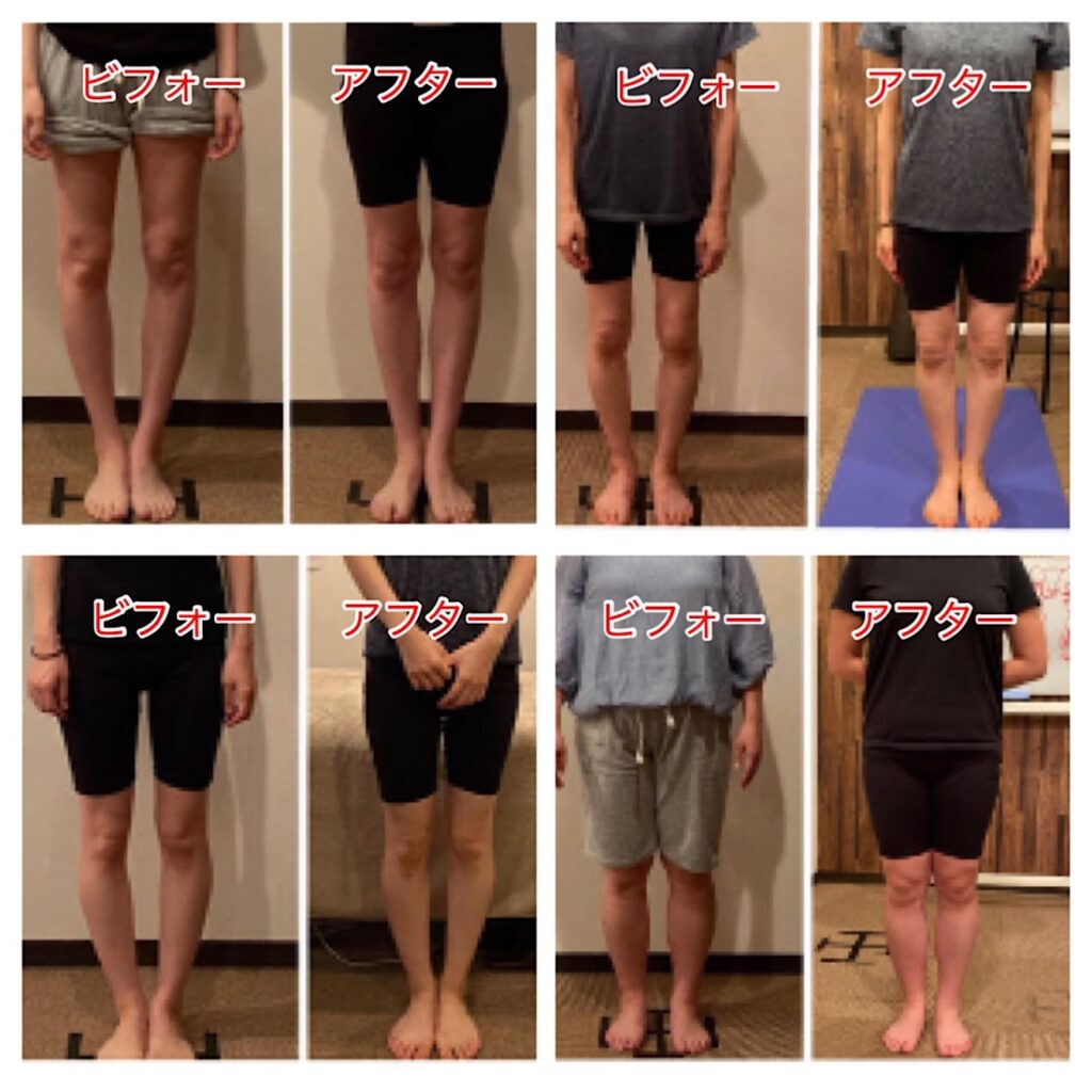 O脚の施術によるビフォーアフター（仙台市もちづき整骨院）
