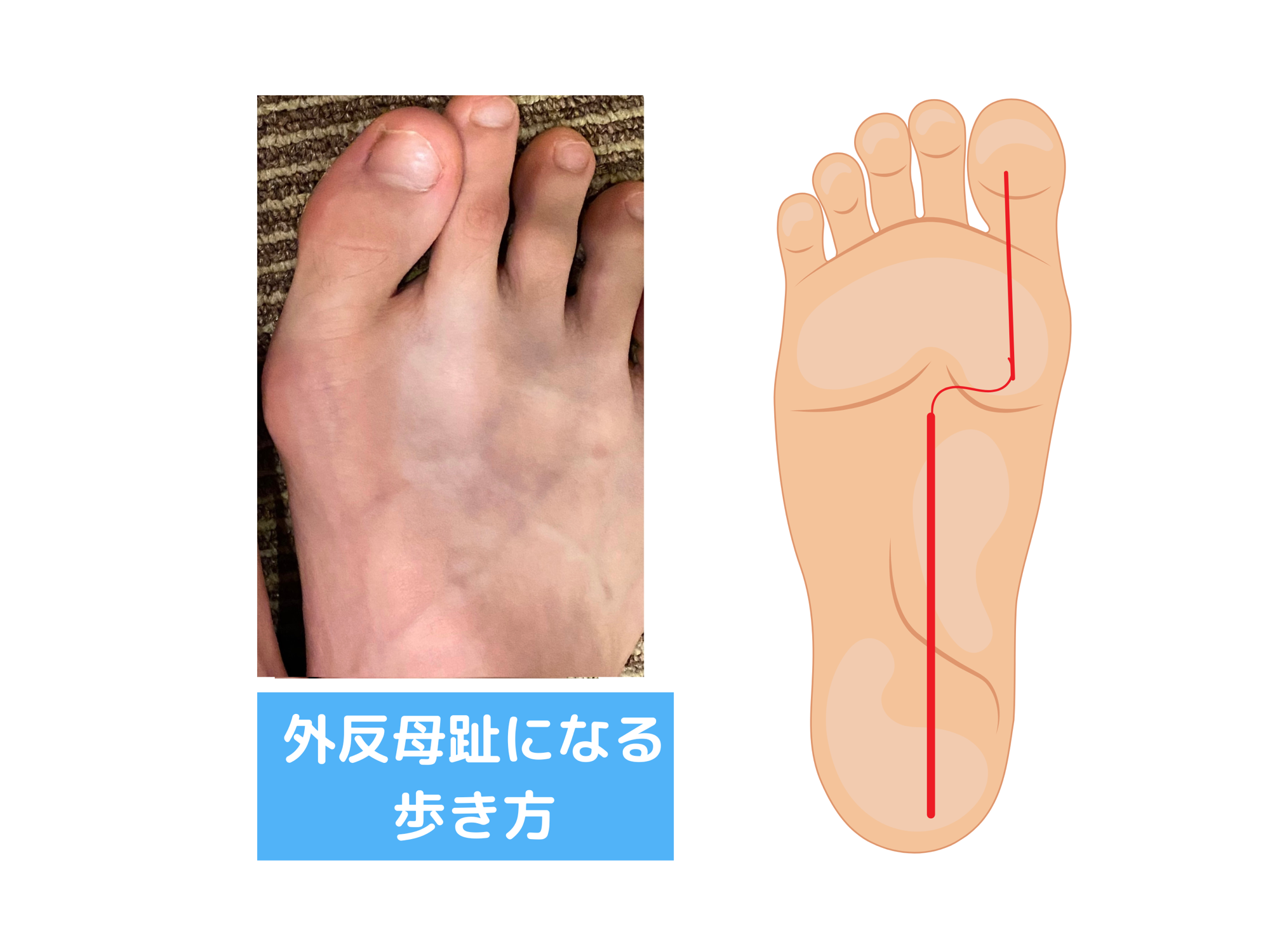 外反母趾 パンプス 仕事 重心の偏り 仙台市もちづき整骨院