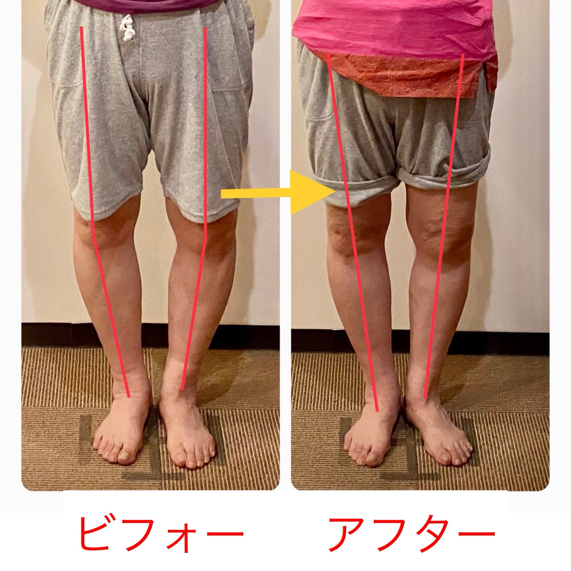 変形性膝関節症とは?40代から増える膝痛の原因・症状・予防法
