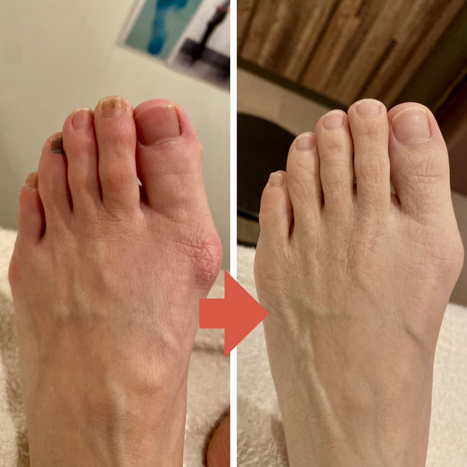 外反母趾 足指の変化