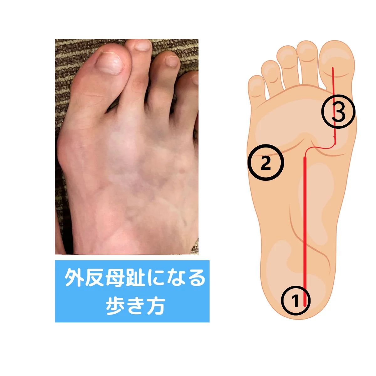 外反母趾になりやすい歩き方。足裏の荷重が内側を直線的に通り、親指の付け根へ横向きの力がかかる