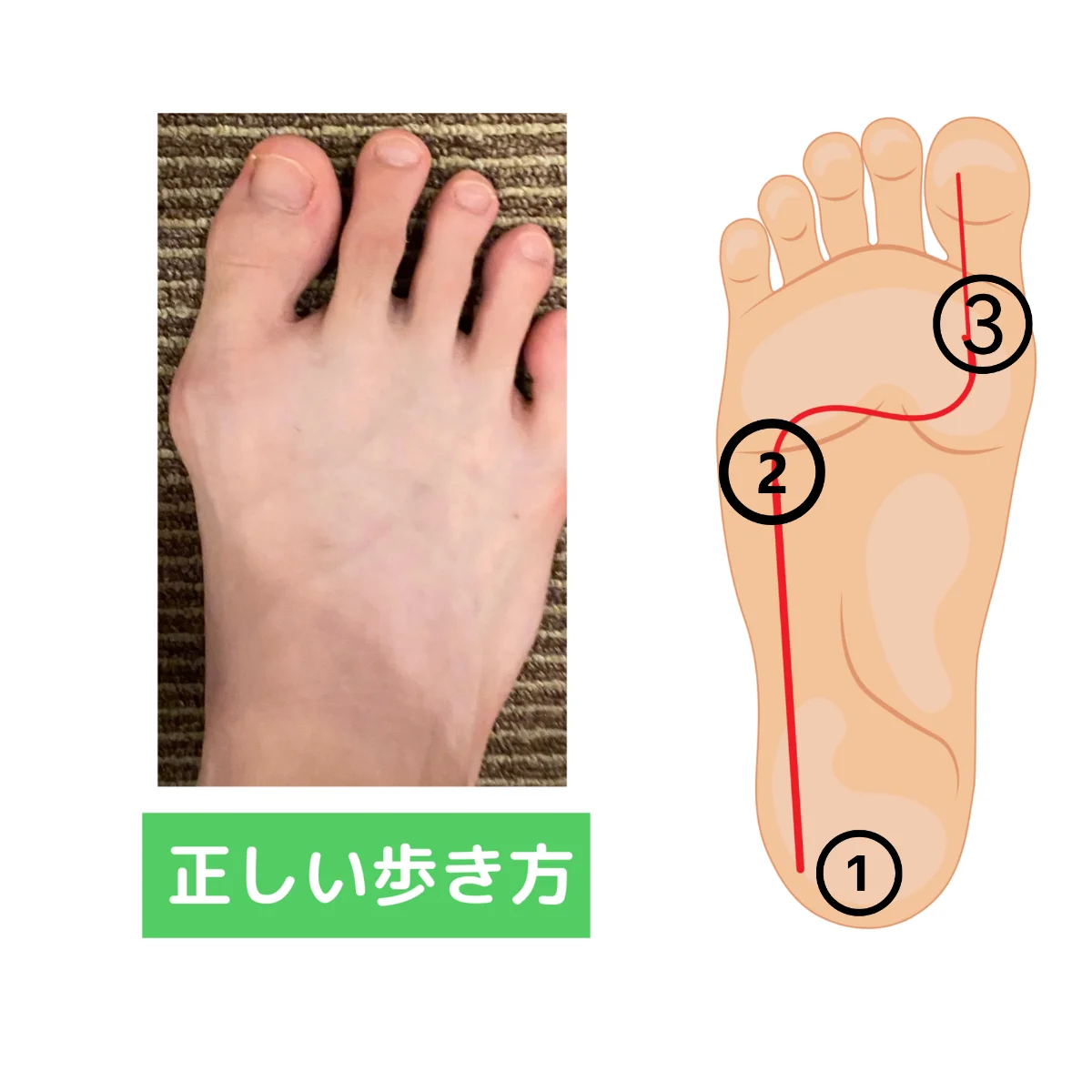 本来の歩き方。足裏の荷重がかかとから外側を通り、親指の付け根へ回り込む