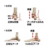 右足を後ろから見た骨格図と横から見た骨格図。荷重がかかったときにアーチが支えきれず内側へ倒れ込む状態の比較