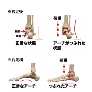 右足を後ろから見た骨格図と横から見た骨格図。荷重がかかったときにアーチが支えきれず内側へ倒れ込む状態の比較