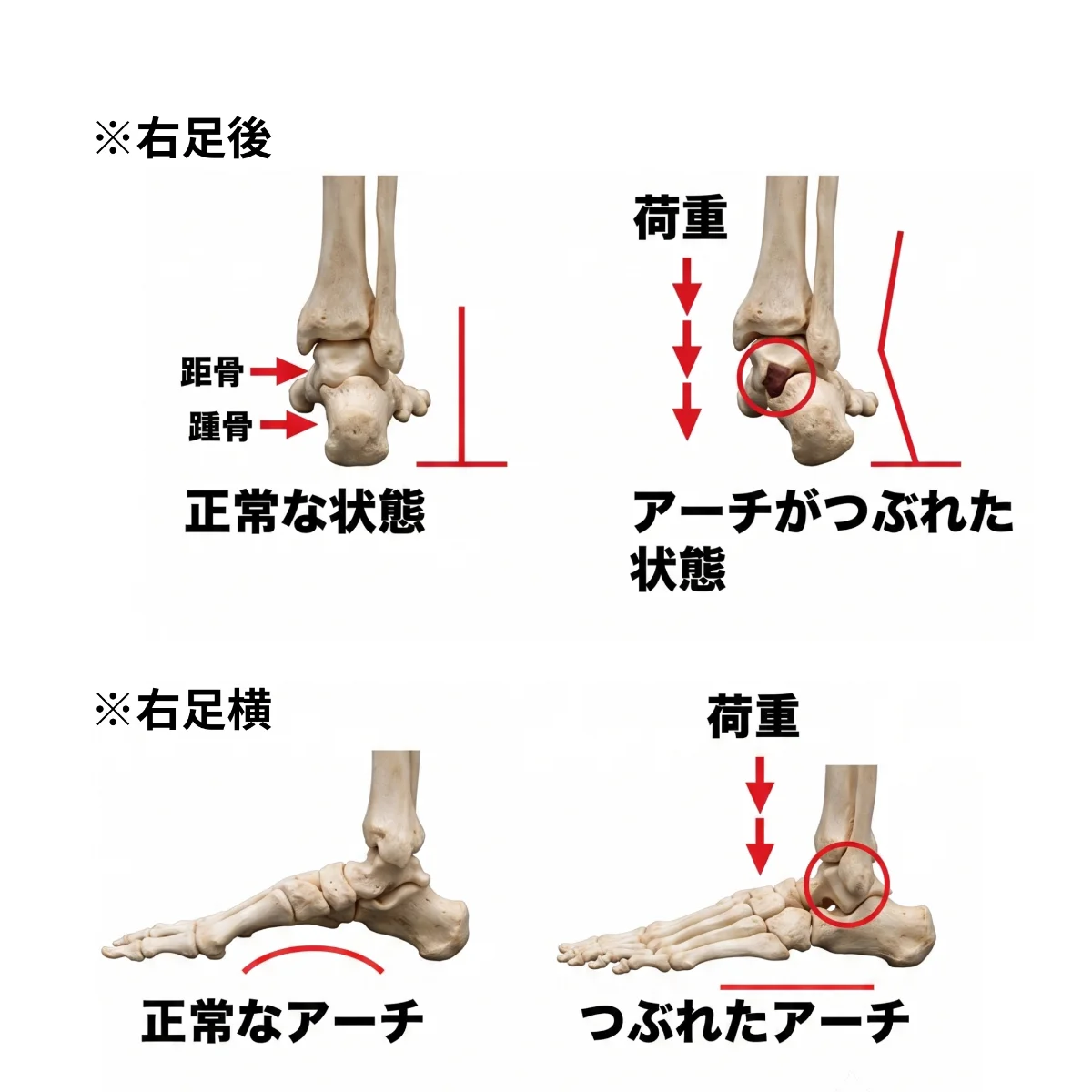 右足を後ろから見た骨格図と横から見た骨格図。荷重がかかったときにアーチが支えきれず内側へ倒れ込む状態の比較