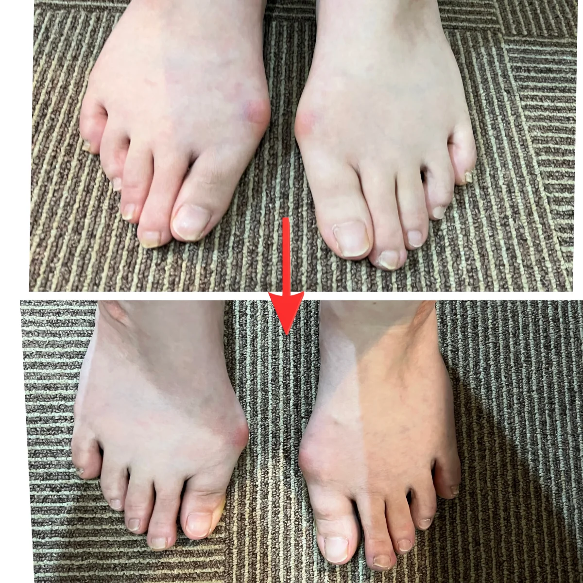 施術前後の足を上から見た比較。親指の向きと指の開き方の変化